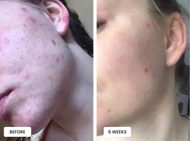 Laduora Duo Red Light Therapy For Skin Before and After_8.jpg__PID:e0277d15-bec1-4ab6-b84c-931709c575f7