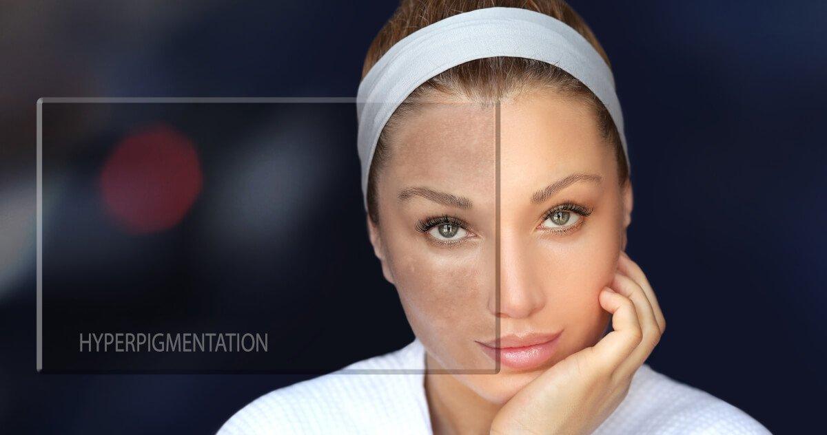 The Truth About Hyperpigmentation : What Causes The Skin To Darken? - Laduora