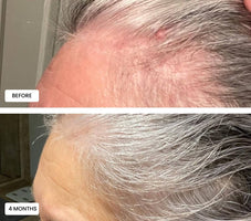 Laduora Duo Red Light Therapy For Hair Before and After_13.jpg__PID:004ce005-ae13-49e0-afbf-3a4feb780185