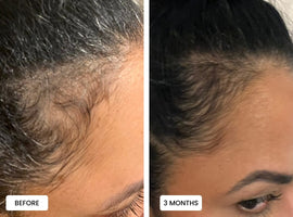 Laduora Duo Red Light Therapy For Hair Before and After_17.jpg__PID:bdc5e5bd-e7fc-4a6b-a8d6-3629410ebef9