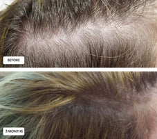 Laduora Duo Red Light Therapy For Hair Before and After_18.jpg__PID:be400c17-2420-4a59-9f42-2c601a35dbb2