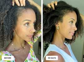 Laduora Duo Red Light Therapy For Hair Before and After_21.jpg__PID:2ad583ac-ad57-49cb-b71b-a4988924d499
