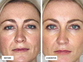 Laduora Duo Red Light Therapy For Skin Before and After_1.jpg__PID:b9a1de98-456b-47f8-a177-4a1849a26b5b