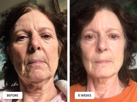 Laduora Duo Red Light Therapy For Skin Before and After_2.jpg__PID:de98456b-d7f8-4177-8a18-49a26b5bca8f