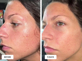Laduora Duo Red Light Therapy For Skin Before and After_3.jpg__PID:456bd7f8-a177-4a18-89a2-6b5bca8fda62