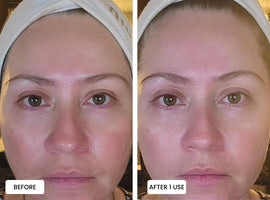 Laduora Duo Red Light Therapy For Skin Before and After_6.jpg__PID:4a1849a2-6b5b-4a8f-9a62-4a059cb24a72