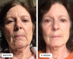 Laduora Velve Pro red light therapy for face before and after2.jpg__PID:7fe2c27e-0501-4803-9444-fda66606d36d