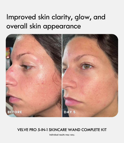 Velve Pro 5 - in - 1 Skincare Wand Complete Kit - Laduora